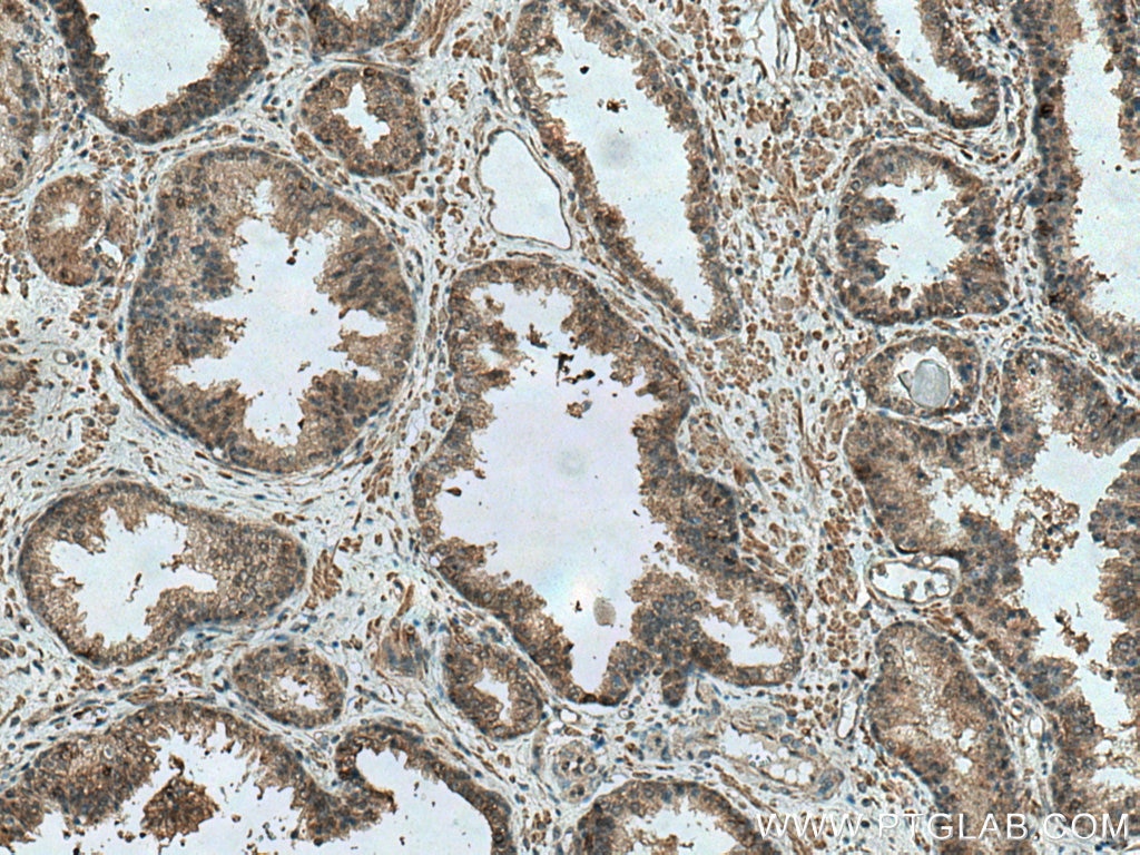 Immunohistochemistry (IHC) staining of human prostate cancer tissue using JNK Monoclonal antibody (66210-1-Ig)