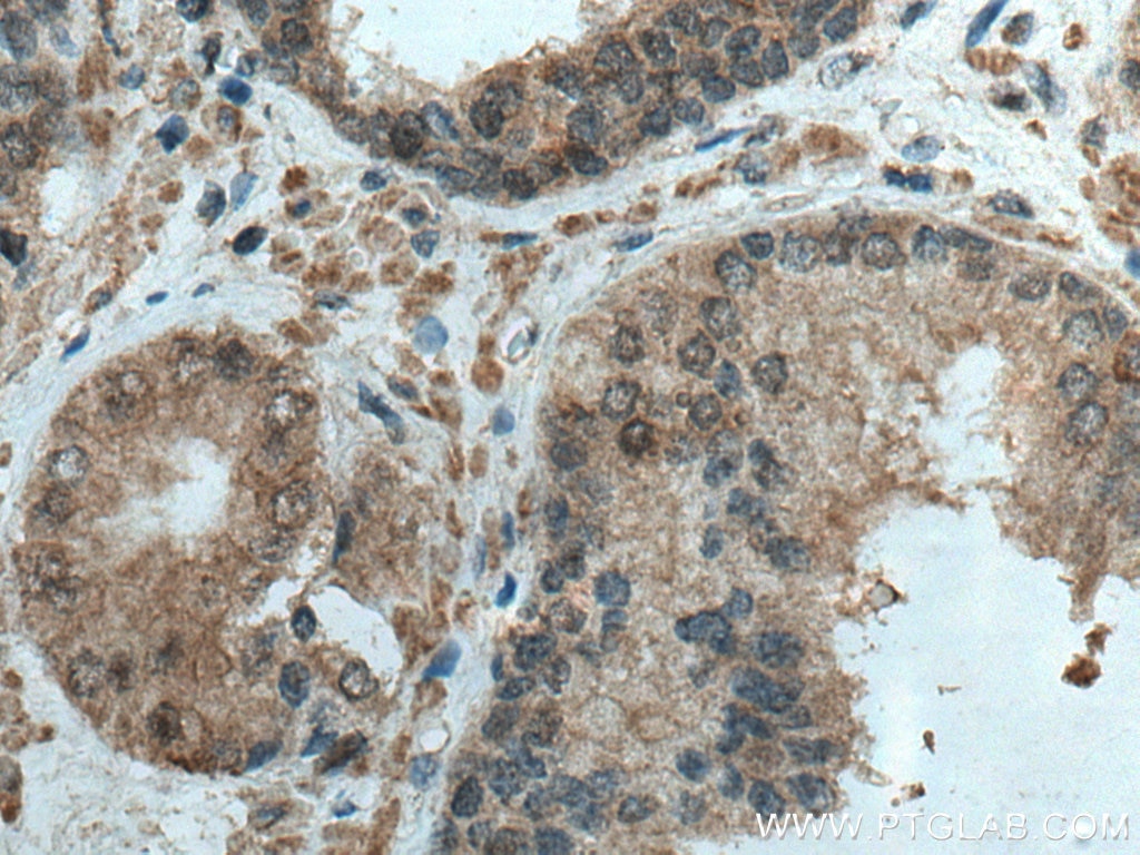 Immunohistochemistry (IHC) staining of human prostate cancer tissue using JNK Monoclonal antibody (66210-1-Ig)