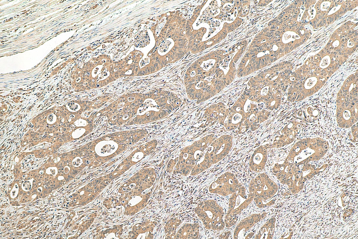 Immunohistochemistry (IHC) staining of human colon cancer tissue using JNK Recombinant antibody (81629-1-RR)