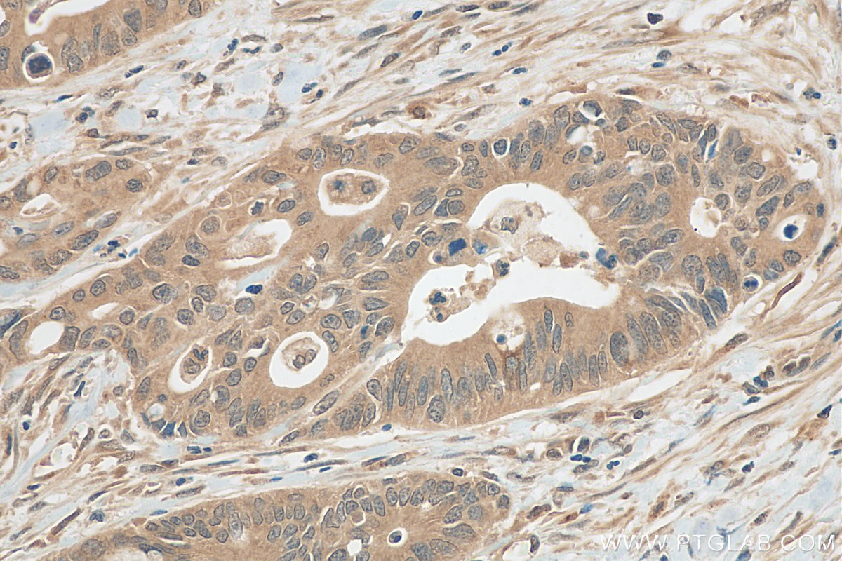Immunohistochemistry (IHC) staining of human colon cancer tissue using JNK Recombinant antibody (81629-1-RR)