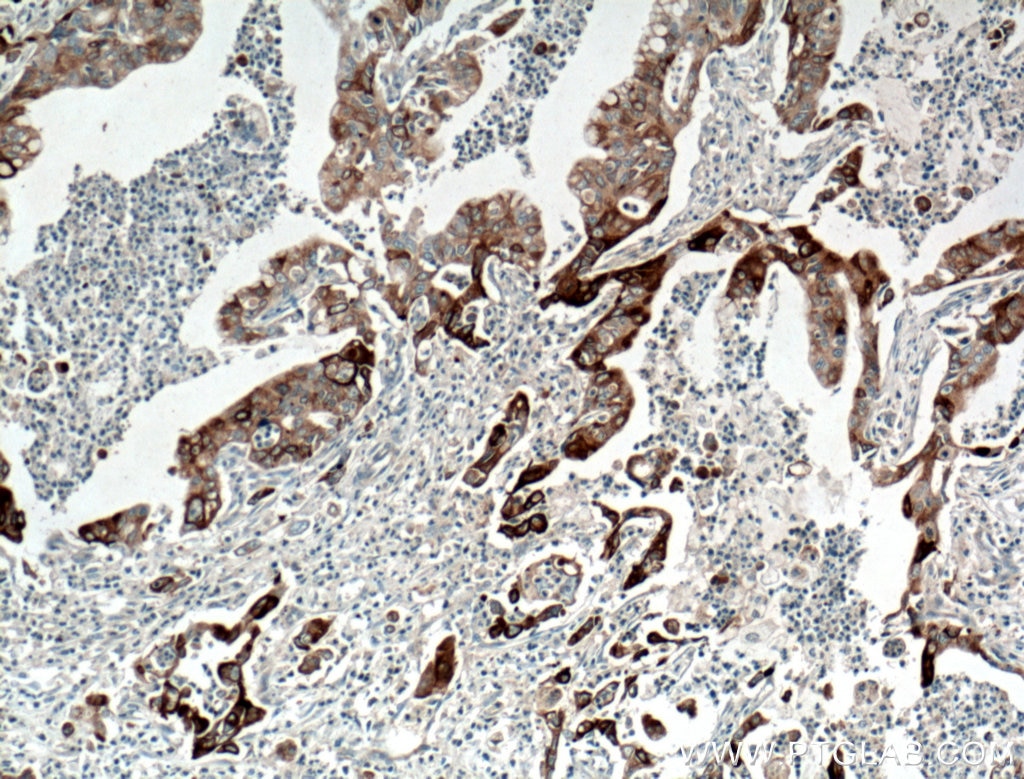 Immunohistochemistry (IHC) staining of human pancreas cancer tissue using JP45/JSRP1 Polyclonal antibody (10854-1-AP)