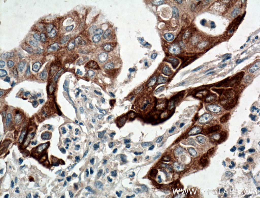 Immunohistochemistry (IHC) staining of human pancreas cancer tissue using JP45/JSRP1 Polyclonal antibody (10854-1-AP)