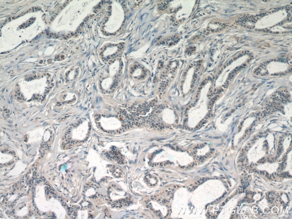 Immunohistochemistry (IHC) staining of human breast cancer tissue using JUN Polyclonal antibody (24909-1-AP)