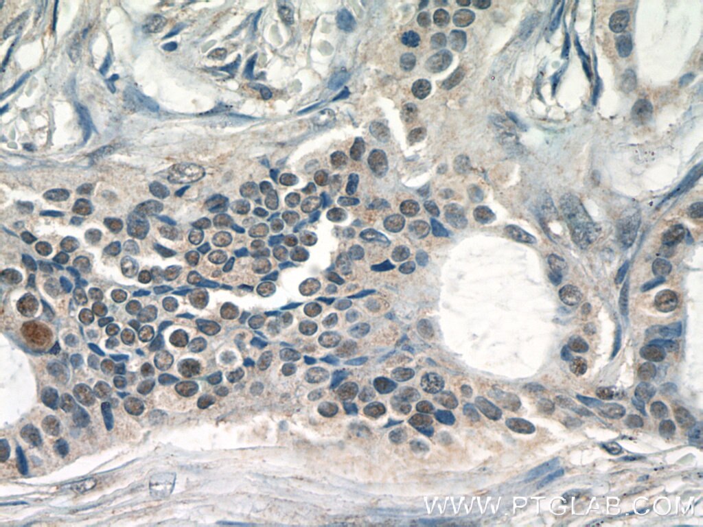 Immunohistochemistry (IHC) staining of human breast cancer tissue using JUN Polyclonal antibody (24909-1-AP)