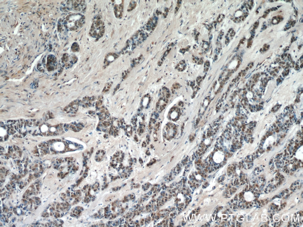 Immunohistochemistry (IHC) staining of human cervical cancer tissue using JUN Polyclonal antibody (24909-1-AP)