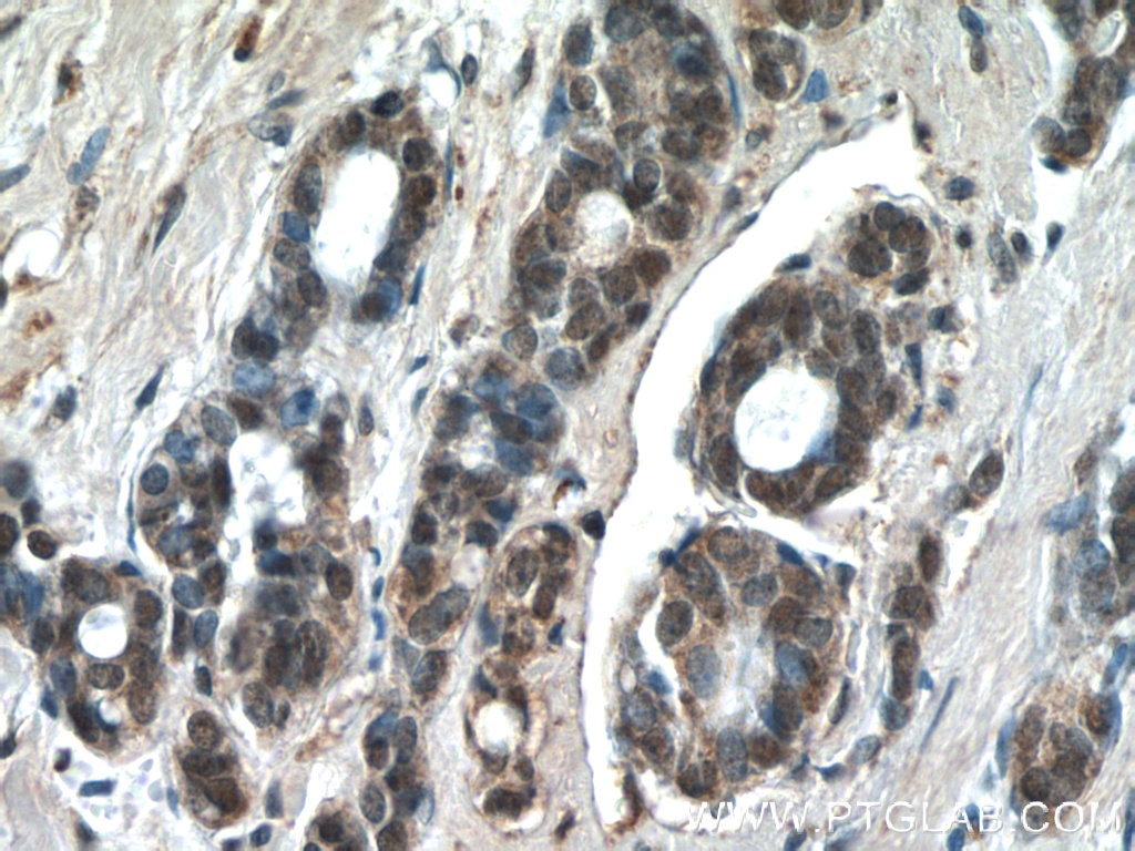 Immunohistochemistry (IHC) staining of human cervical cancer tissue using JUN Polyclonal antibody (24909-1-AP)