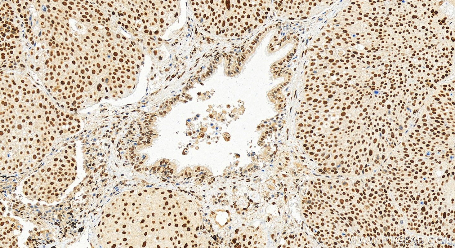 Immunohistochemistry (IHC) staining of human lung squamous cell cancer using JUN Polyclonal antibody (24909-1-AP)