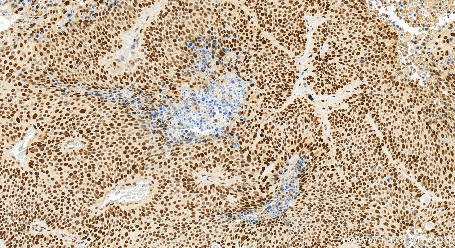 Immunohistochemistry (IHC) staining of human lung squamous cell cancer using JUN Polyclonal antibody (24909-1-AP)