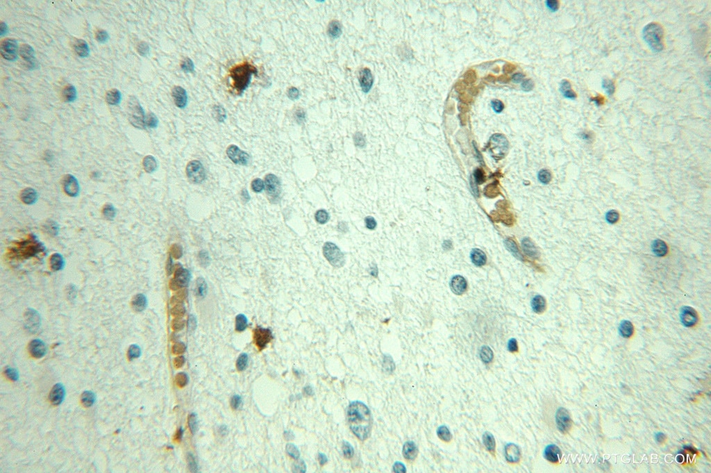 IHC staining of human gliomas using 10486-1-AP