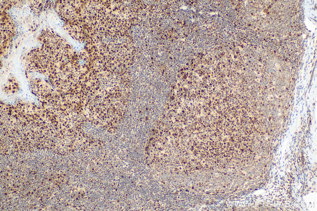 IHC staining of human tonsillitis using RMX00032 Immunohistochemistry (IHC) staining of human tonsillitis tissue using Multi-rAb® JUNB Multi-Recombinant antibody (RMX00032)