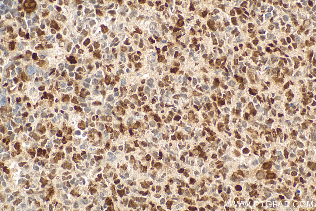 IHC staining of human tonsillitis using RMX00032 Immunohistochemistry (IHC) staining of human tonsillitis tissue using Multi-rAb® JUNB Multi-Recombinant antibody (RMX00032)