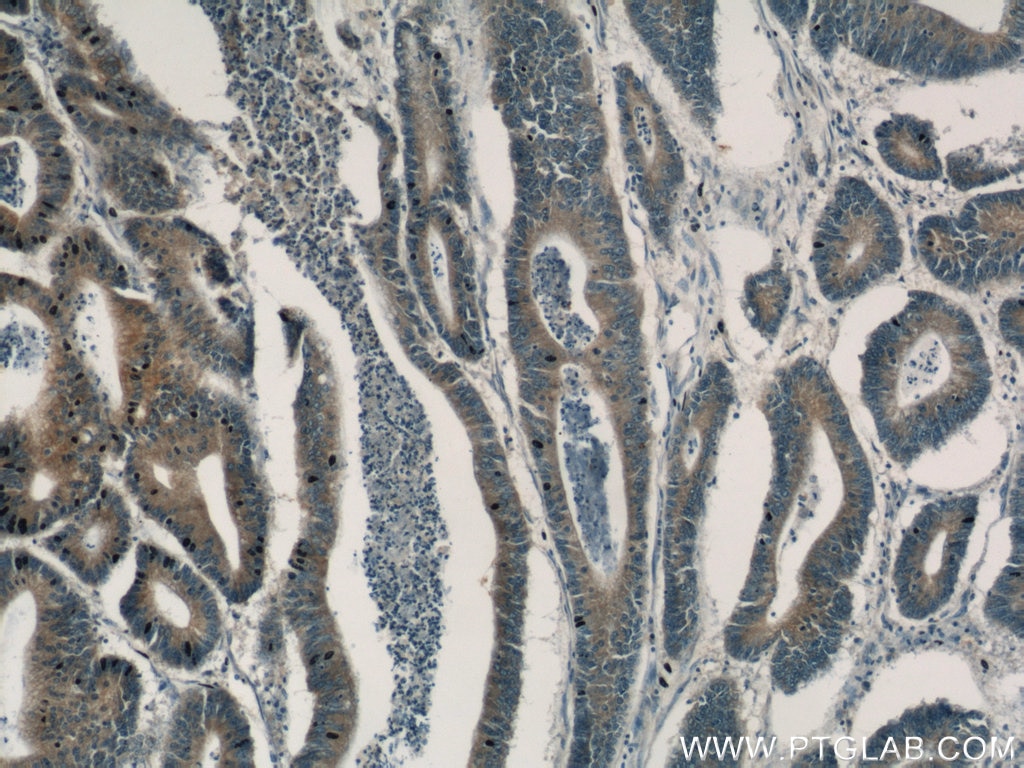 Immunohistochemistry (IHC) staining of human colon cancer tissue using Gamma Catenin Polyclonal antibody (11146-1-AP)