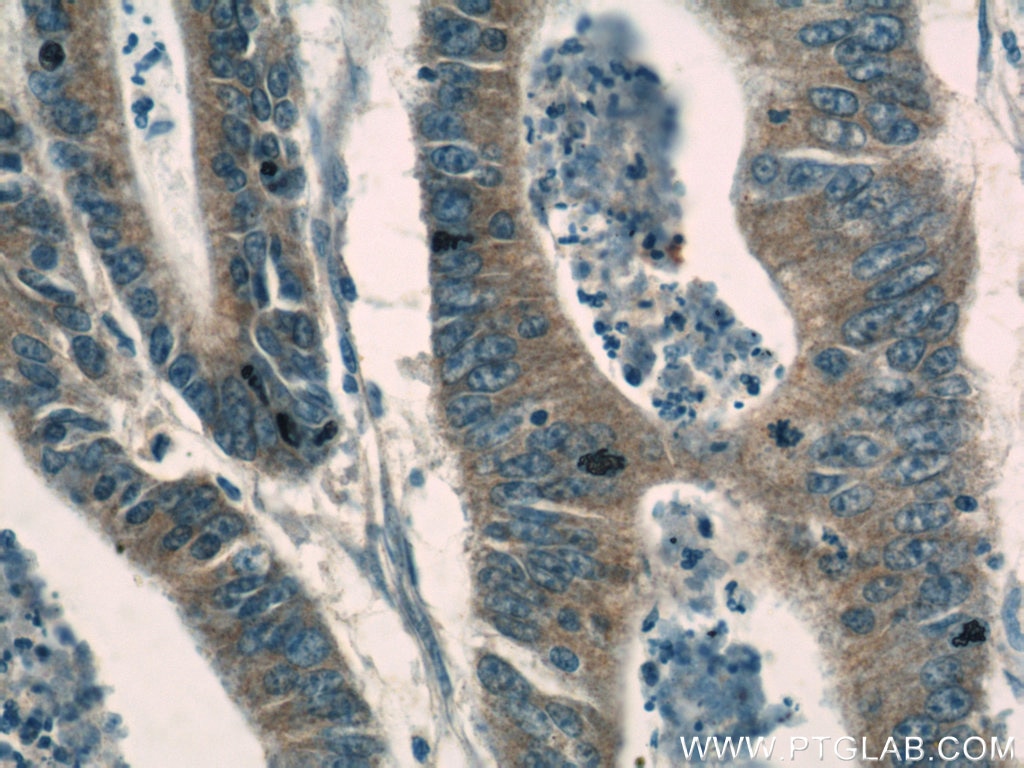 Immunohistochemistry (IHC) staining of human colon cancer tissue using Gamma Catenin Polyclonal antibody (11146-1-AP)