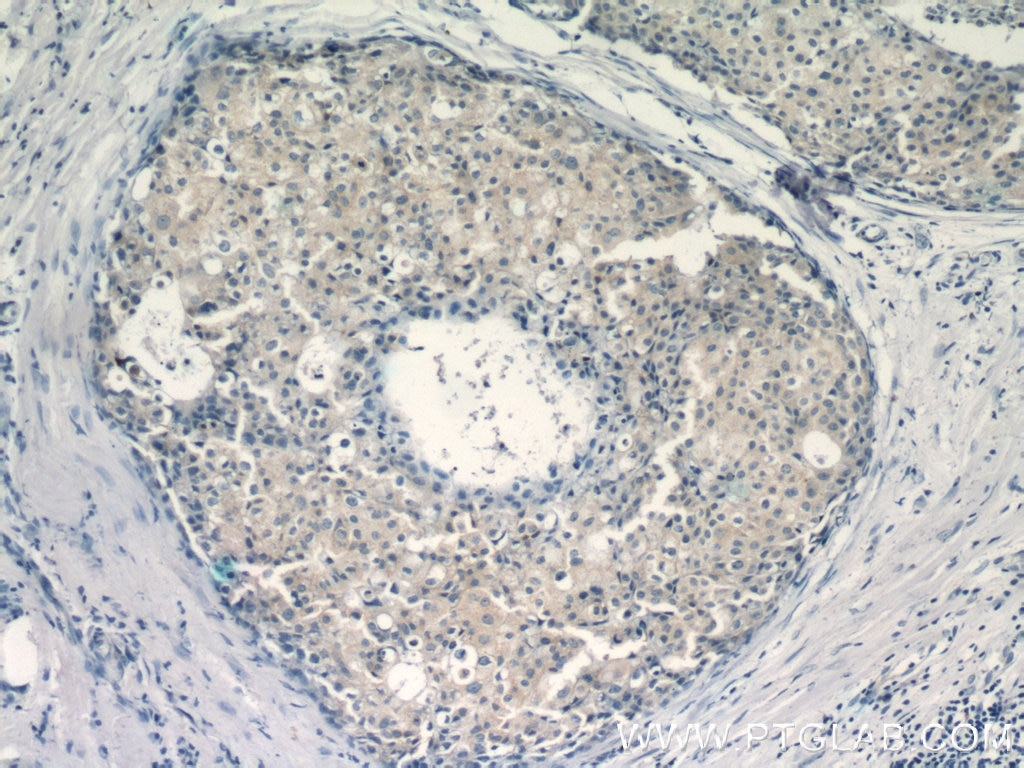 Immunohistochemistry (IHC) staining of human breast cancer tissue using Gamma Catenin Polyclonal antibody (11146-1-AP)