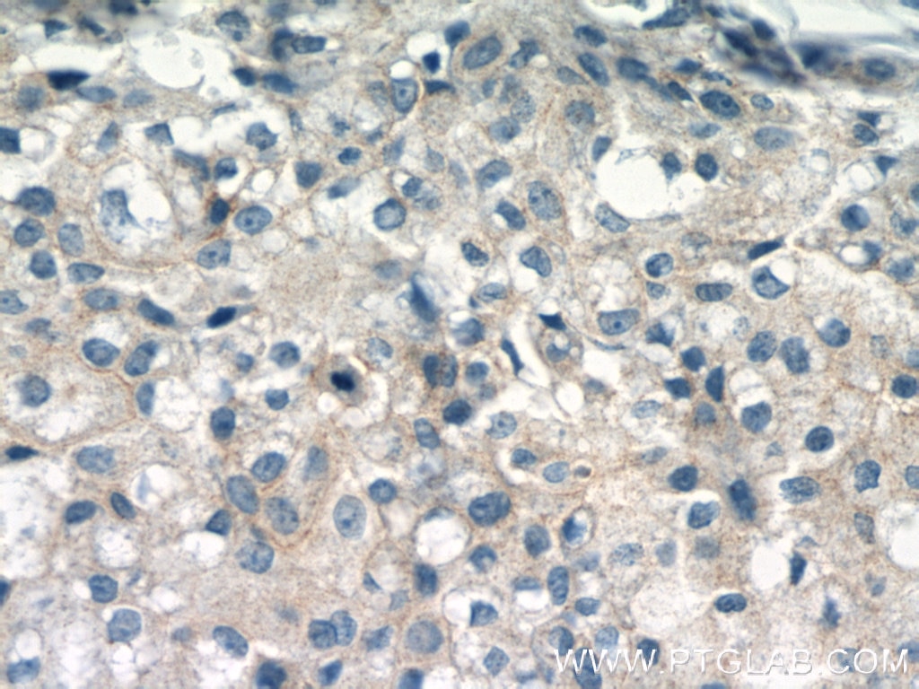 Immunohistochemistry (IHC) staining of human breast cancer tissue using Gamma Catenin Polyclonal antibody (11146-1-AP)