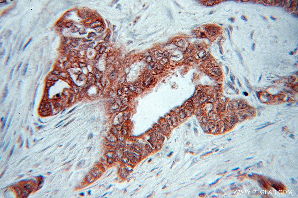 Immunohistochemistry (IHC) staining of human pancreas cancer tissue using Gamma Catenin Polyclonal antibody (11146-1-AP)