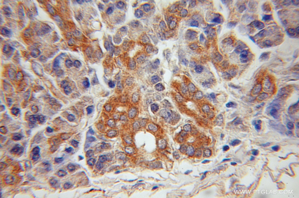 IHC staining of human pancreas cancer using 51054-2-AP