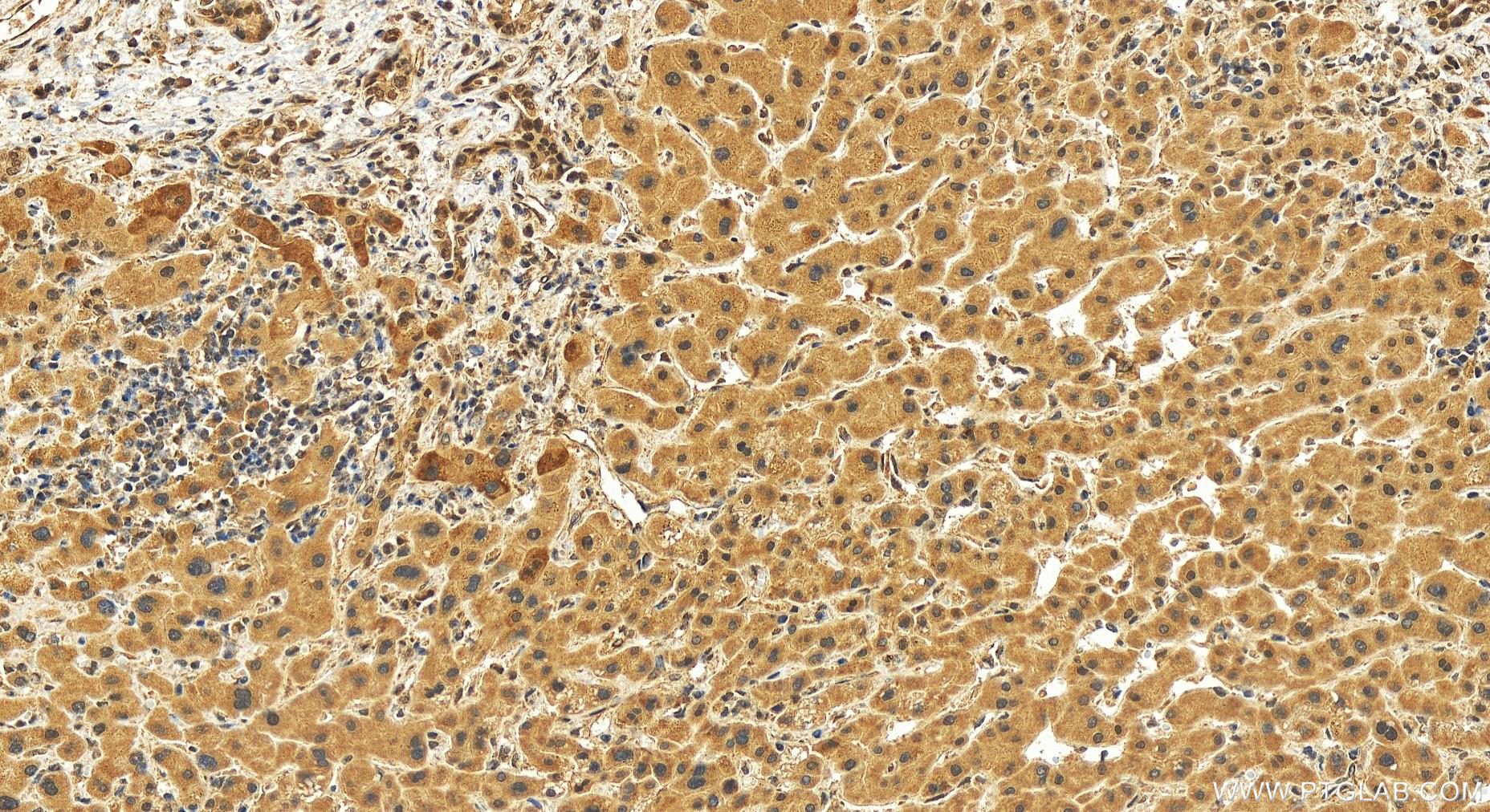 Immunohistochemistry (IHC) staining of human intrahepatic cholangiocarcinoma tissue using KANSL3 Polyclonal antibody (25533-1-AP)