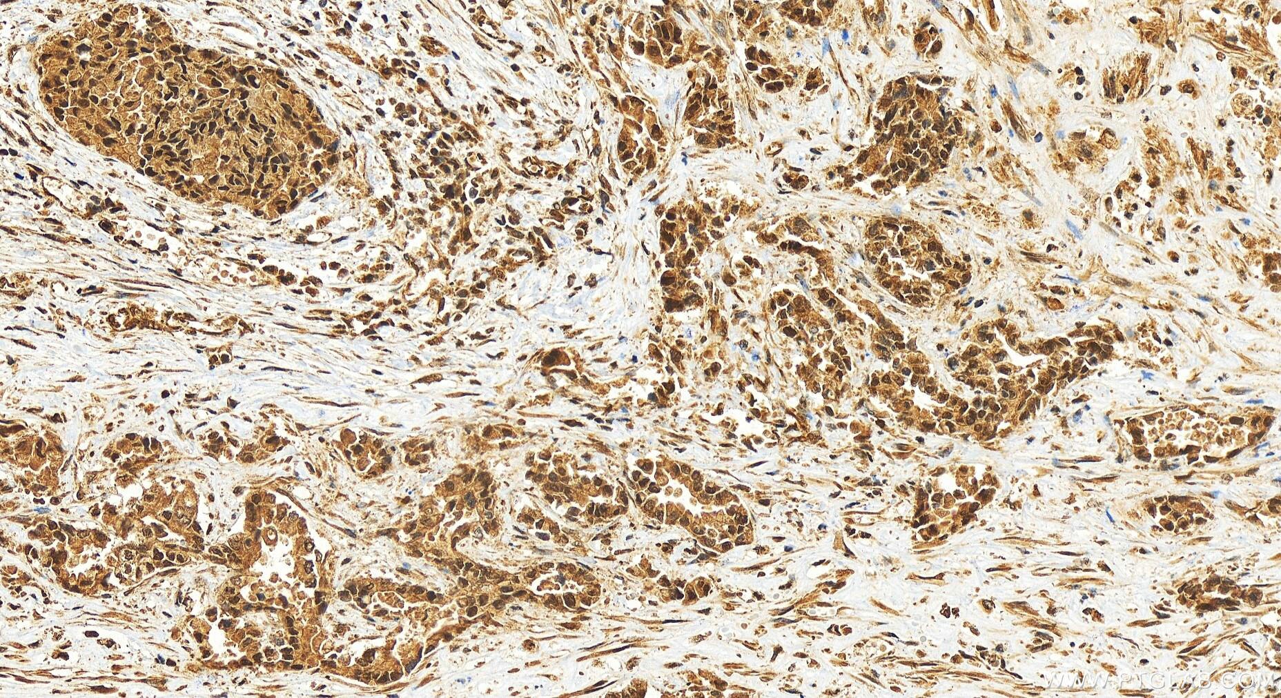 Immunohistochemistry (IHC) staining of human intrahepatic cholangiocarcinoma tissue using KANSL3 Polyclonal antibody (25533-1-AP)