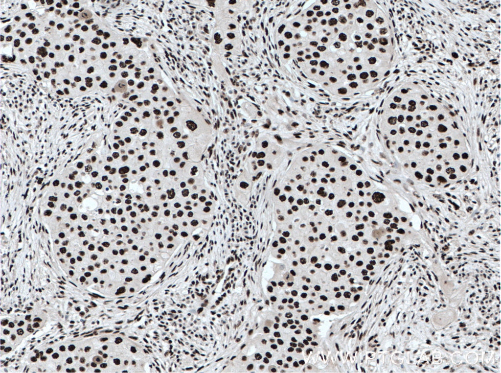 Immunohistochemistry (IHC) staining of human breast cancer tissue using KAP1 Monoclonal antibody (66630-1-Ig)