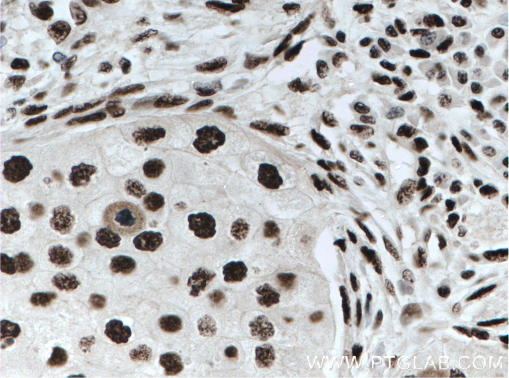 Immunohistochemistry (IHC) staining of human breast cancer tissue using KAP1 Monoclonal antibody (66630-1-Ig)