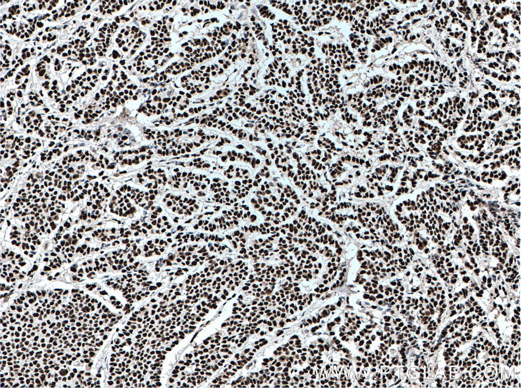Immunohistochemistry (IHC) staining of human colon cancer tissue using KAP1 Monoclonal antibody (66630-1-Ig)