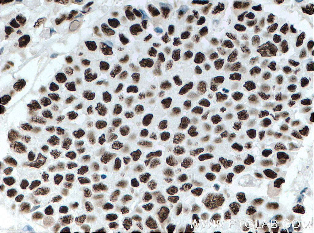 Immunohistochemistry (IHC) staining of human colon cancer tissue using KAP1 Monoclonal antibody (66630-1-Ig)