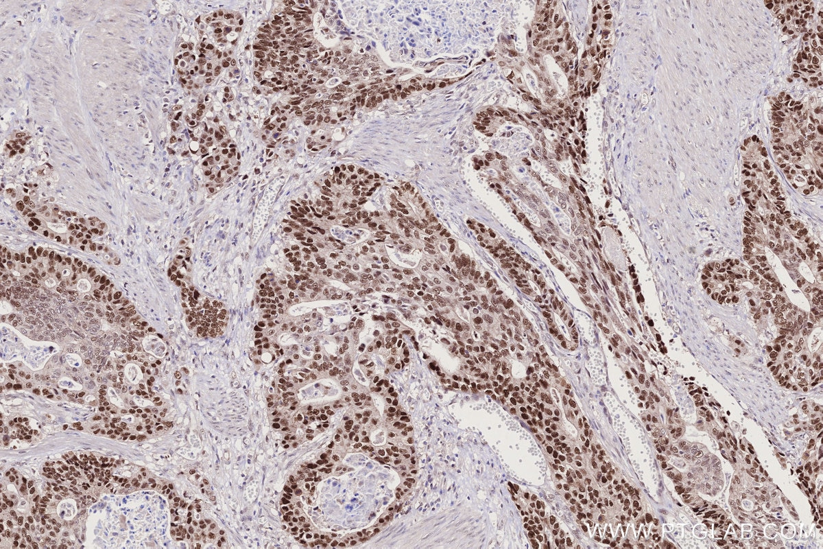 Immunohistochemistry (IHC) staining of human stomach cancer tissue using KAT2A/GCN5 Recombinant monoclonal antibody (84669-2-RR)
