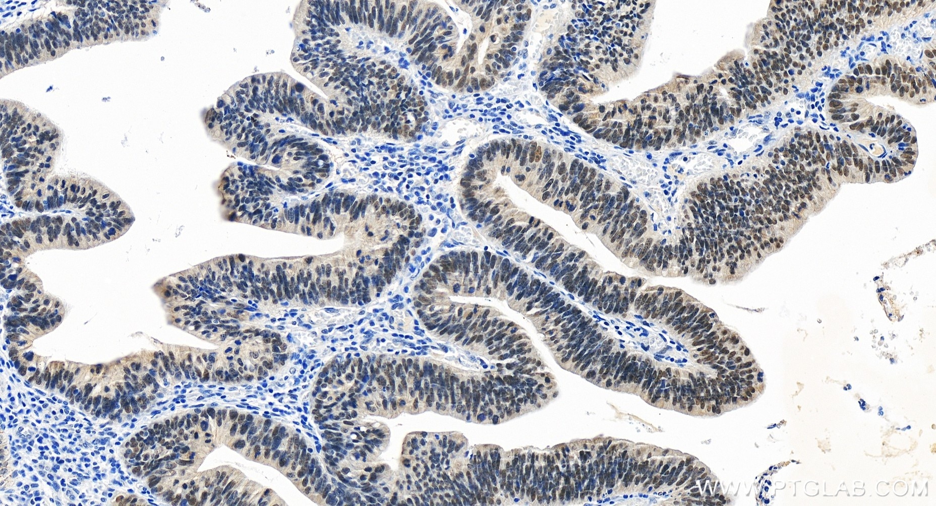 Immunohistochemistry (IHC) staining of human colon cancer tissue using KAT2A/GCN5 Recombinant antibody (84669-2-RR)