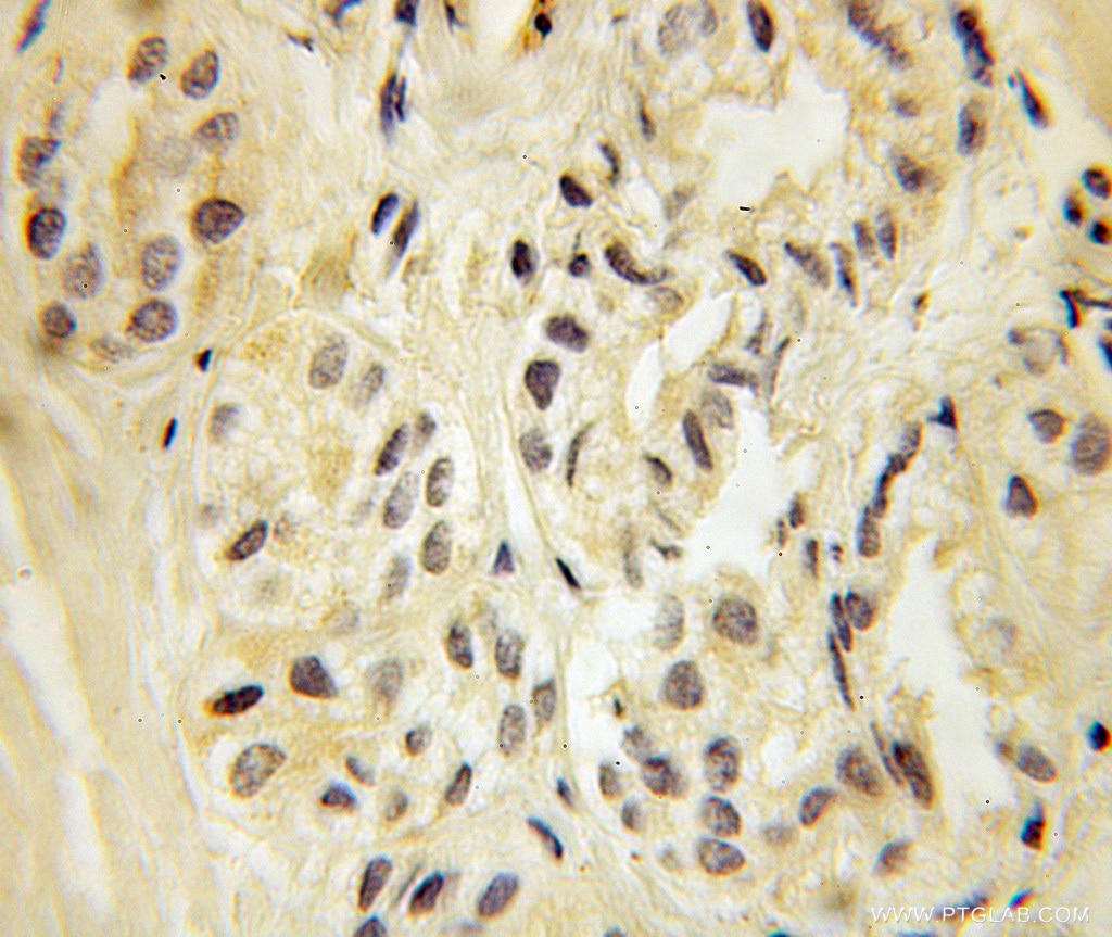Immunohistochemistry (IHC) staining of human prostate cancer tissue using TIP60/KAT5 Polyclonal antibody (10827-1-AP)