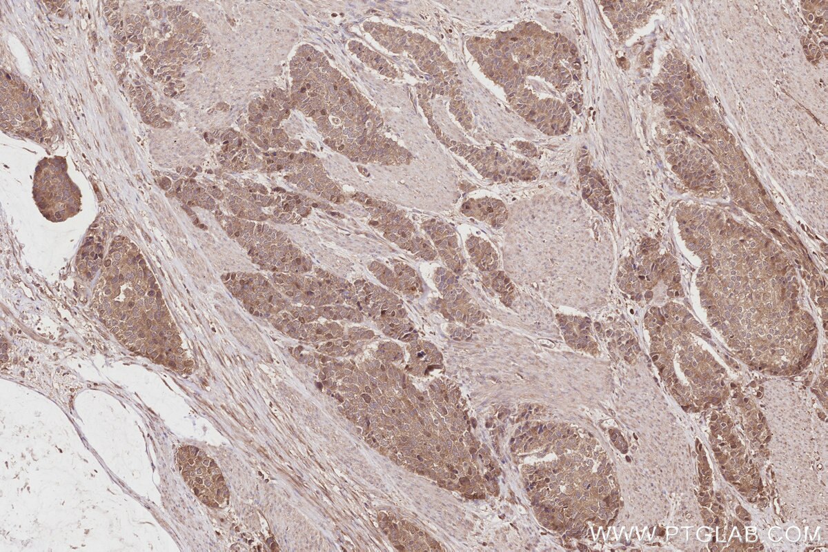Immunohistochemistry (IHC) staining of human stomach cancer tissue using KATNB1 Polyclonal antibody (14969-1-AP)