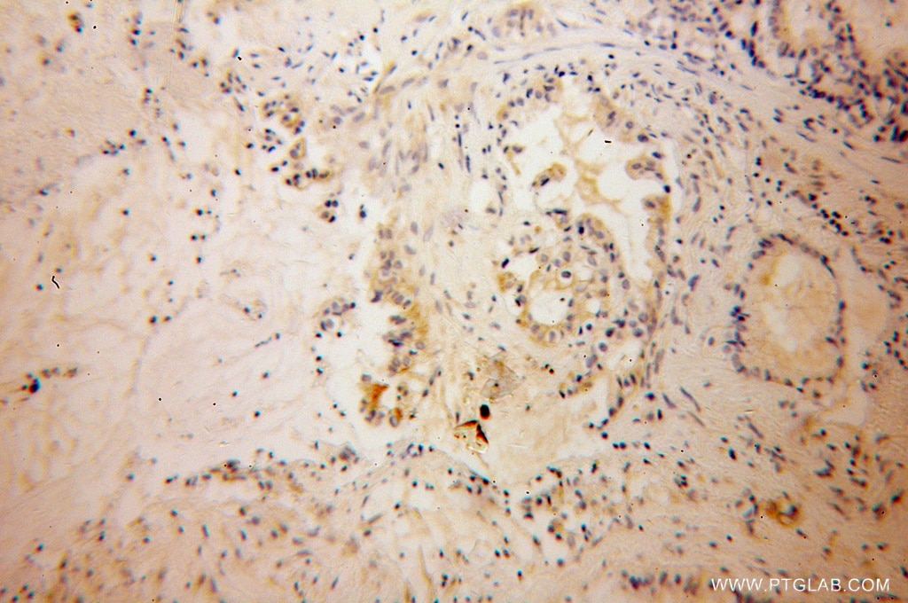 Immunohistochemistry (IHC) staining of human pancreas cancer tissue using KCNF1 Polyclonal antibody (13191-1-AP)