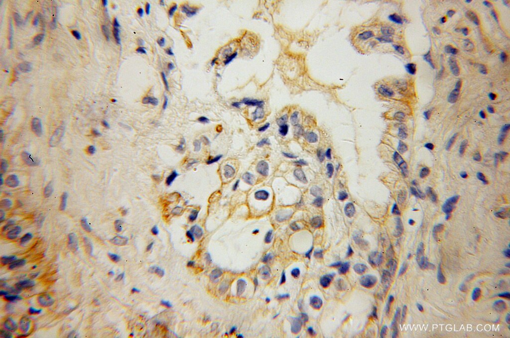 Immunohistochemistry (IHC) staining of human pancreas cancer tissue using KCNF1 Polyclonal antibody (13191-1-AP)