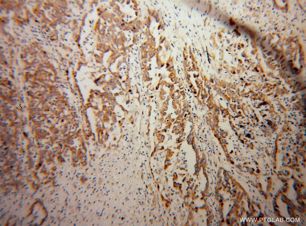 Immunohistochemistry (IHC) staining of human pancreas cancer tissue using KChIP1 Polyclonal antibody (14212-1-AP)