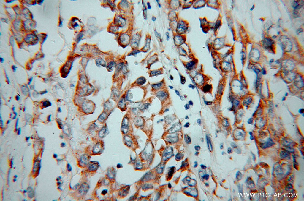 Immunohistochemistry (IHC) staining of human pancreas cancer tissue using KChIP1 Polyclonal antibody (14212-1-AP)