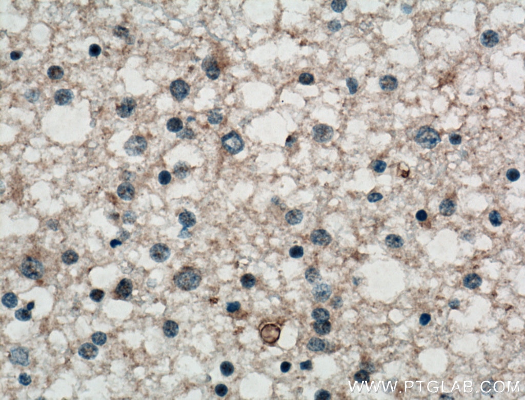 Immunohistochemistry (IHC) staining of human gliomas tissue using KCNIP3 Polyclonal antibody (12032-1-AP)