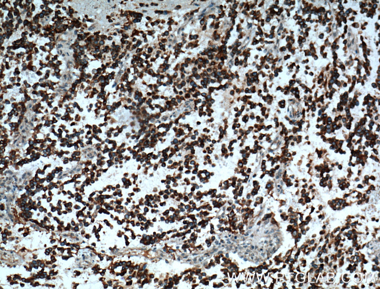 IHC staining of human gliomas using 12503-1-AP