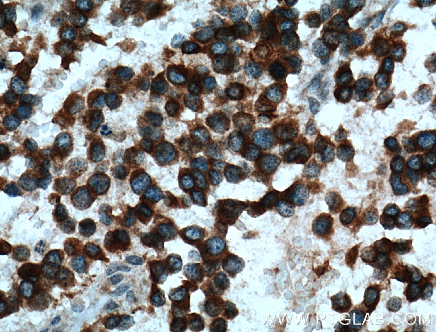 Immunohistochemistry (IHC) staining of human gliomas tissue using Kir4.1 Polyclonal antibody (12503-1-AP)