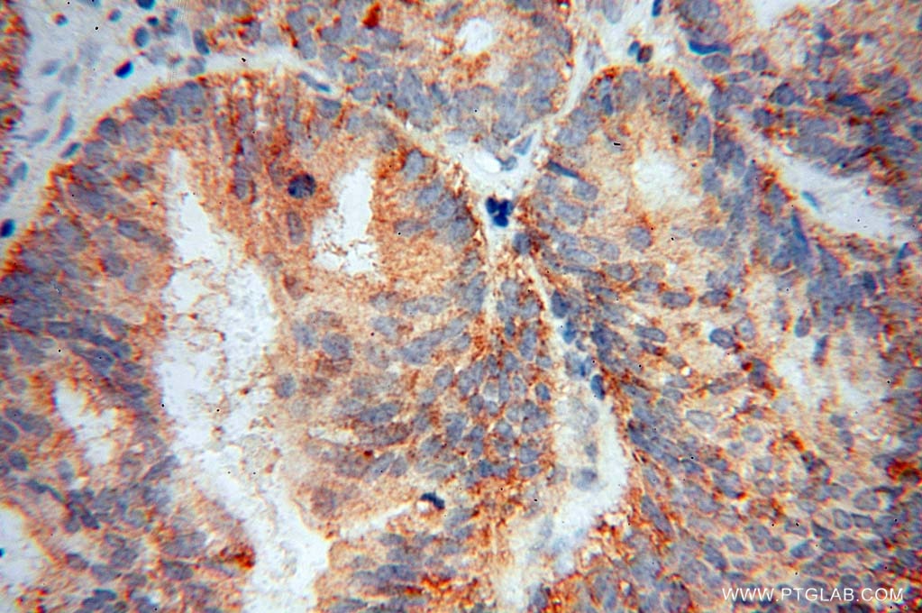 Immunohistochemistry (IHC) staining of human ovary tumor tissue using KCTD2/5/17 Polyclonal antibody (15553-1-AP)
