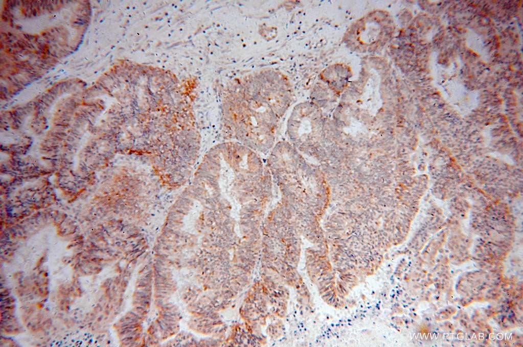 Immunohistochemistry (IHC) staining of human ovary tumor tissue using KCTD2/5/17 Polyclonal antibody (15553-1-AP)