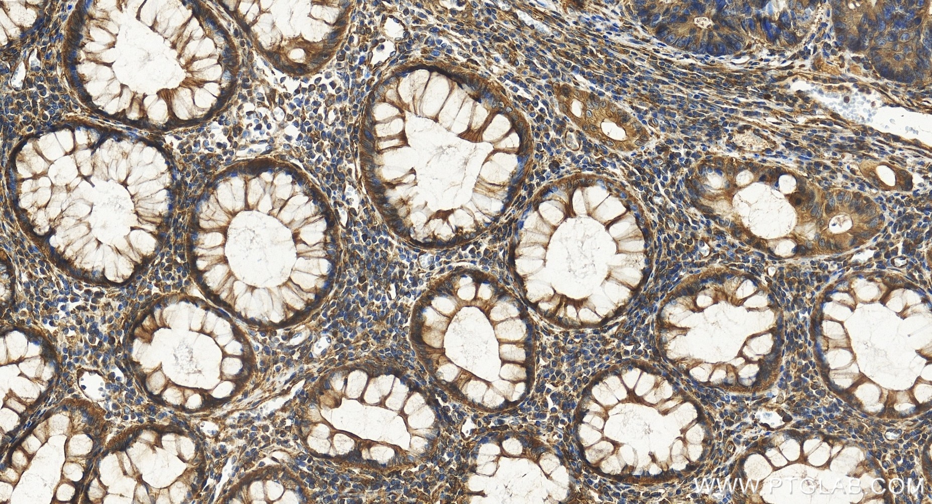 Immunohistochemical analysis of paraffin-embedded human colon cancer tissue slide using 85210-4-RR (KCTD5 antibody) at dilution of 1:500 (under 20x lens). Heat mediated antigen retrieval with Tris-EDTA buffer (pH 9.0). Immunohistochemistry (IHC) staining of human colon cancer tissue using KCTD5 Recombinant monoclonal antibody (85210-4-RR)
