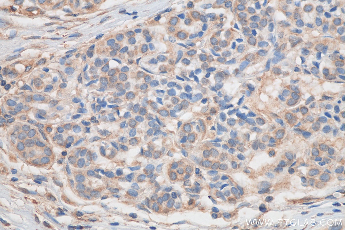 Immunohistochemistry (IHC) staining of human breast cancer tissue using KDELC2 Polyclonal antibody (23345-1-AP)