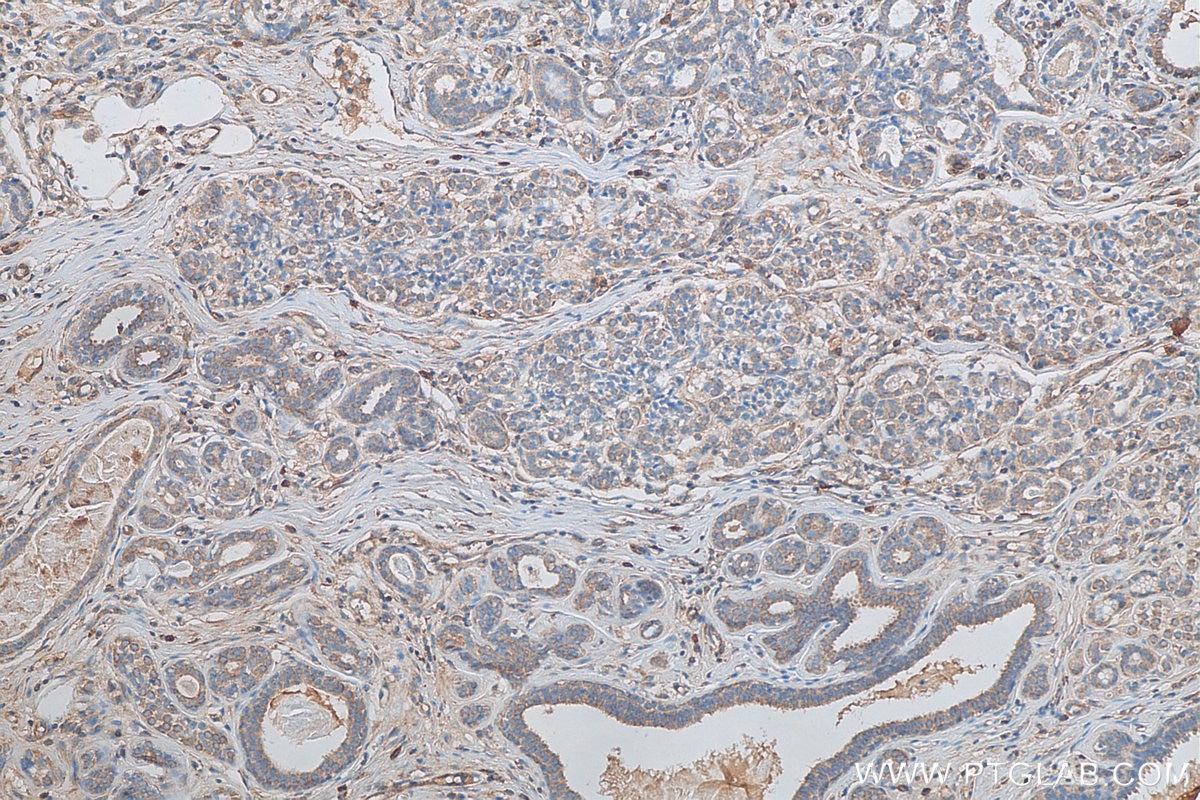 Immunohistochemistry (IHC) staining of human breast cancer tissue using KDELC2 Polyclonal antibody (23345-1-AP)