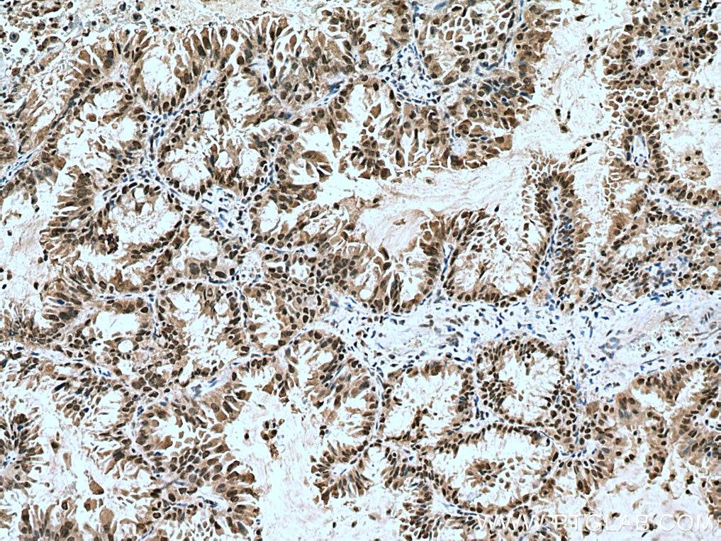 Immunohistochemistry (IHC) staining of human lung cancer tissue using KDM1 Polyclonal antibody (20813-1-AP)