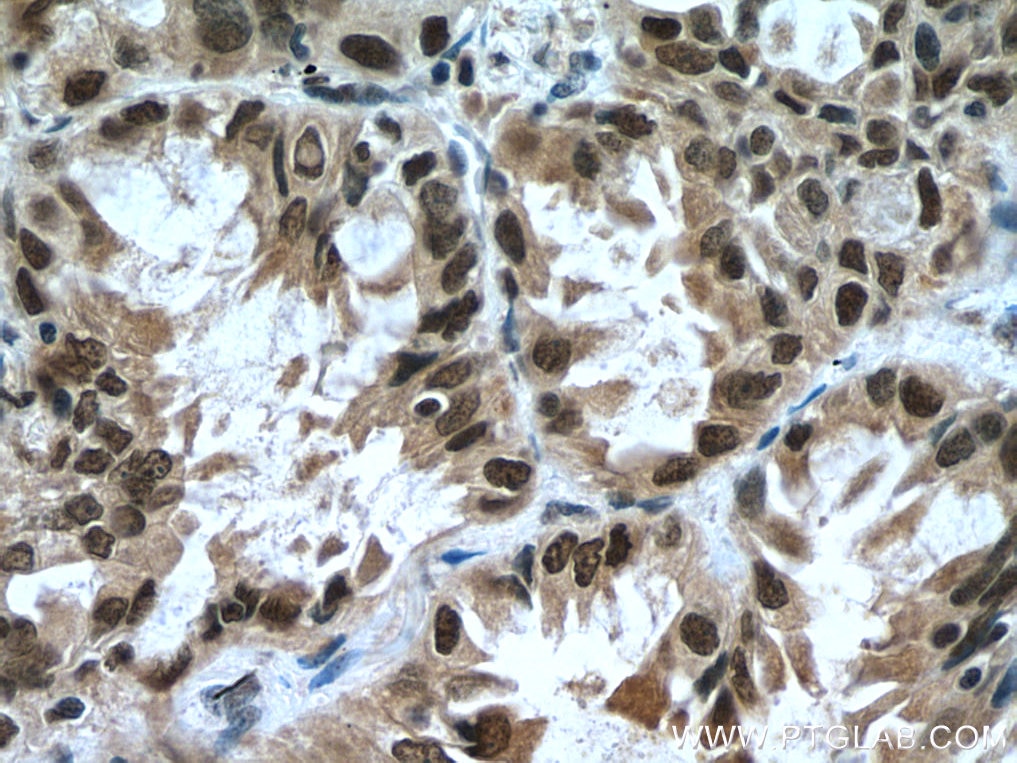 Immunohistochemistry (IHC) staining of human lung cancer tissue using KDM1 Polyclonal antibody (20813-1-AP)