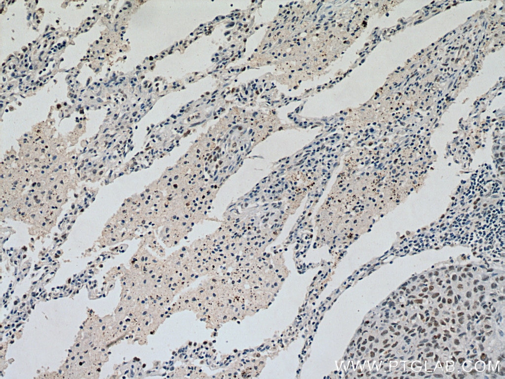 Immunohistochemistry (IHC) staining of human lung cancer tissue using KDM1 Monoclonal antibody (67037-1-Ig)