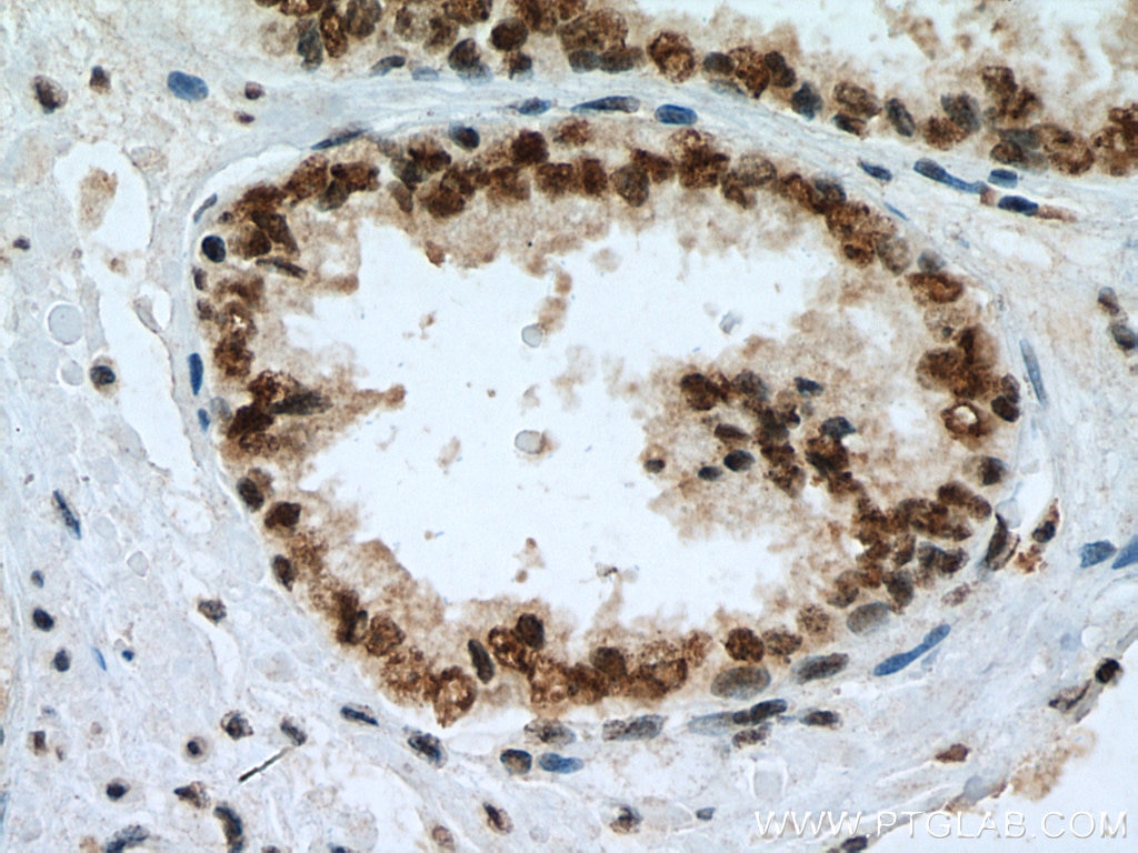 Immunohistochemistry (IHC) staining of human prostate cancer tissue using KDM1 Monoclonal antibody (67037-1-Ig)
