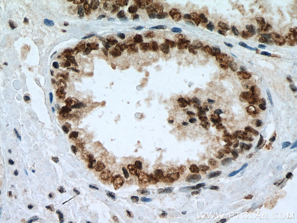 IHC staining of human prostate cancer using 67037-1-Ig