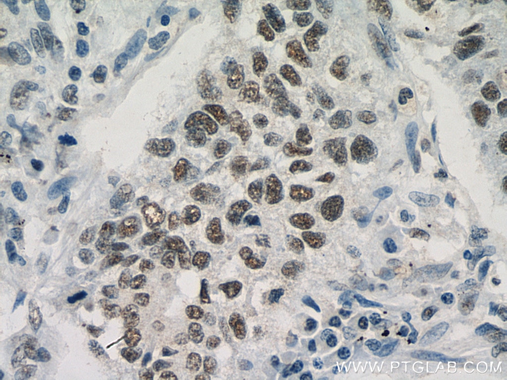 Immunohistochemistry (IHC) staining of human lung cancer tissue using KDM1 Monoclonal antibody (67037-1-Ig)