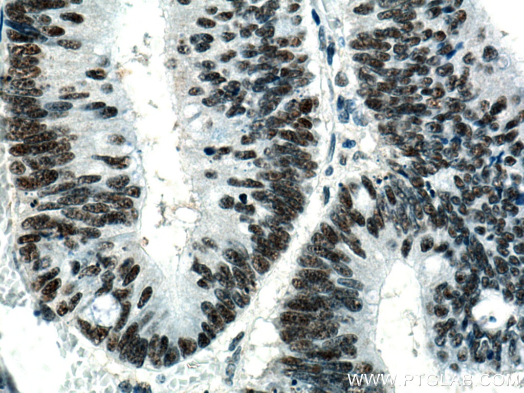 Immunohistochemistry (IHC) staining of human colon cancer tissue using KDM1 Monoclonal antibody (67037-1-Ig)